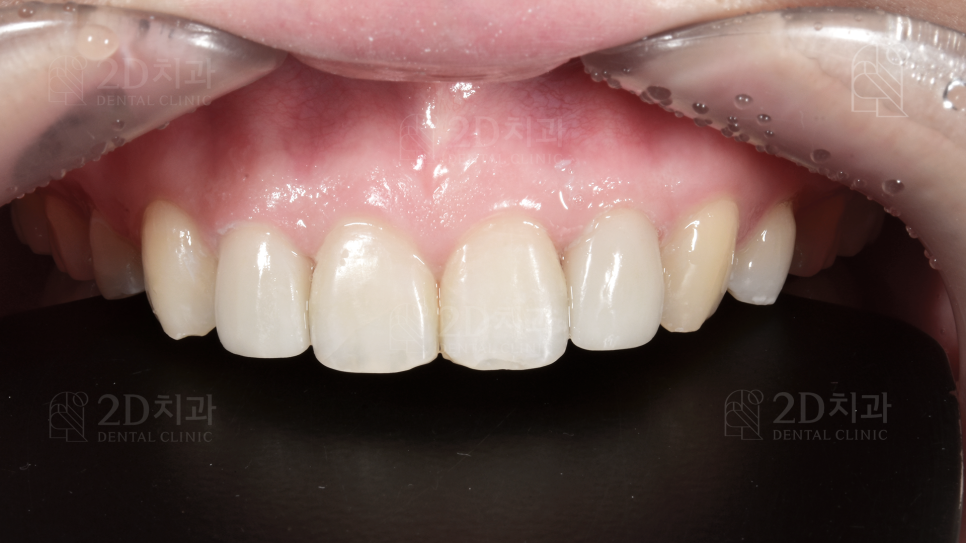 왜소치 라미네이트  신논현역 2D치과 관련 이미지 6