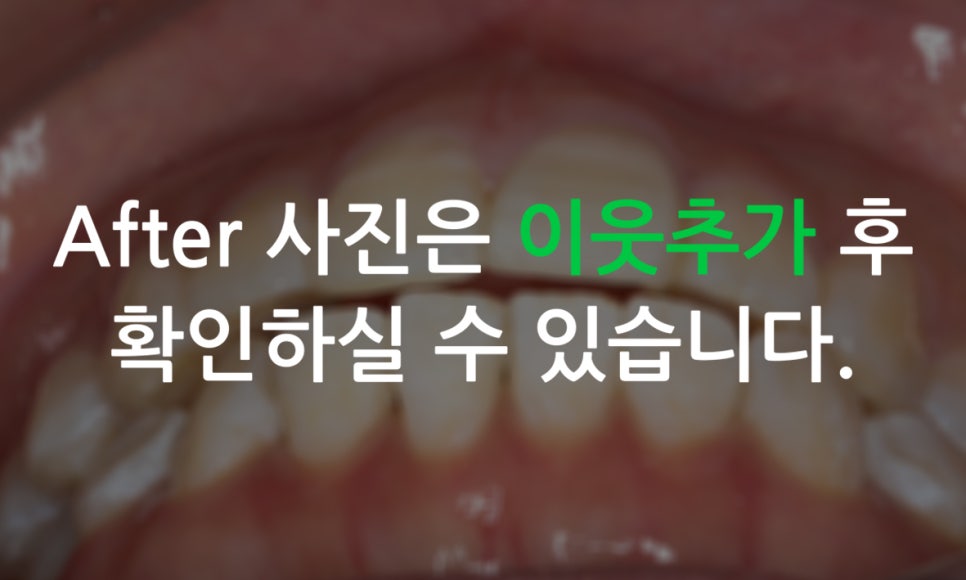 앞니돌출 급속교정 Case feat. 2D교정 관련 이미지 14