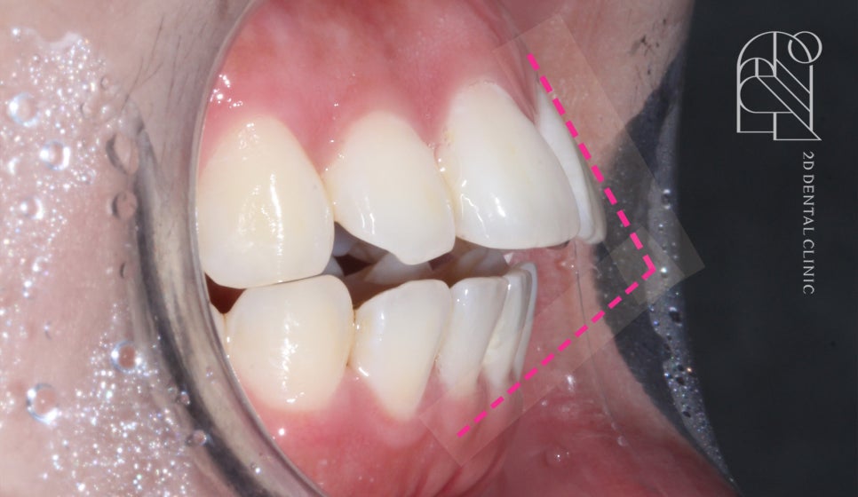 부정교합 치아교정, 전체교정으로 완성하기! by. 투디치과(2D치과) 관련 이미지 10