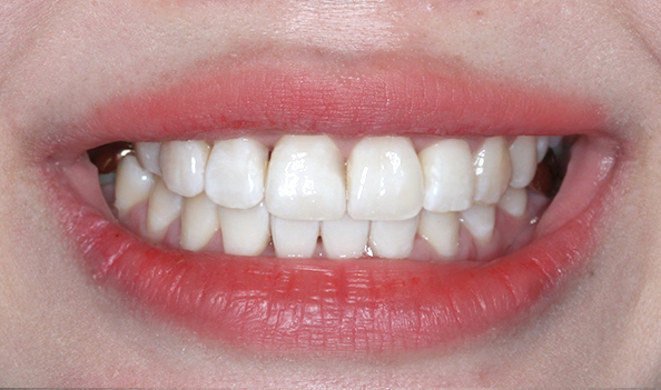 2D치과 2D교정으로 4개월만에 덧니 개선! 관련 이미지 10