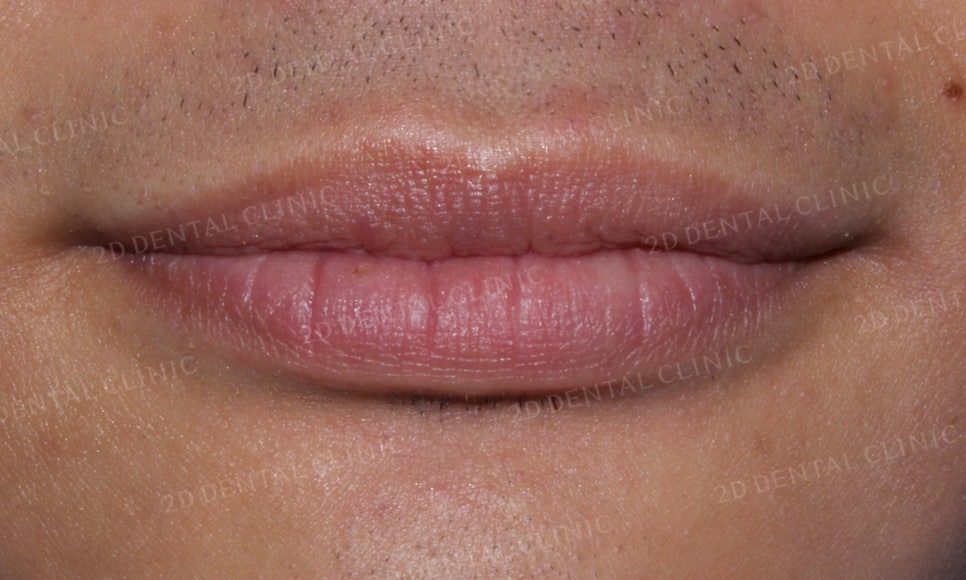 [앞니교정] 벌어진 앞니, 부분교정으로 앞니교정하기! by.2D치과(투디치과) 관련 이미지 2