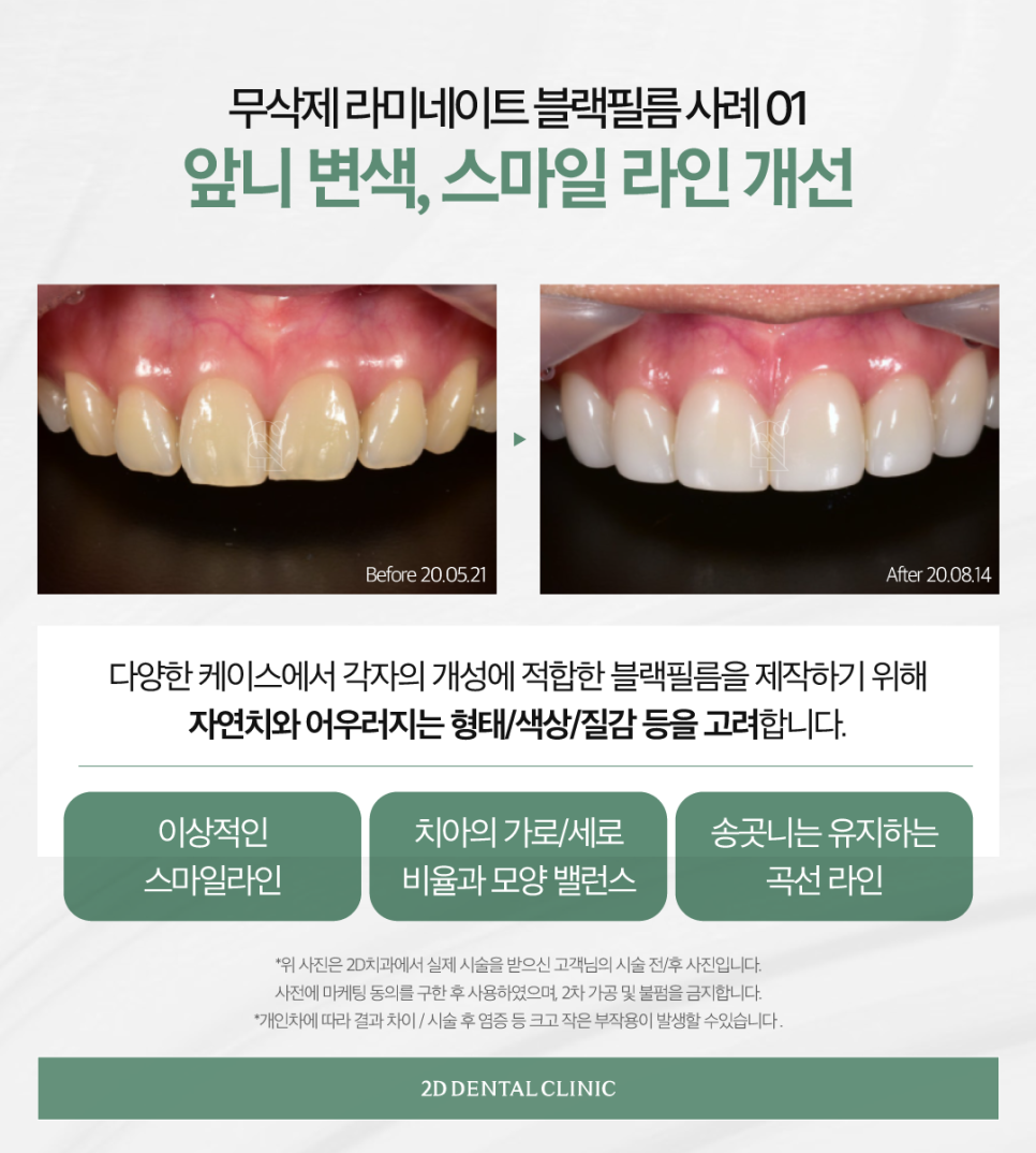 라미네이트하는이유 앞니심미치료 더욱 아름다운 치아로! 관련 이미지 4