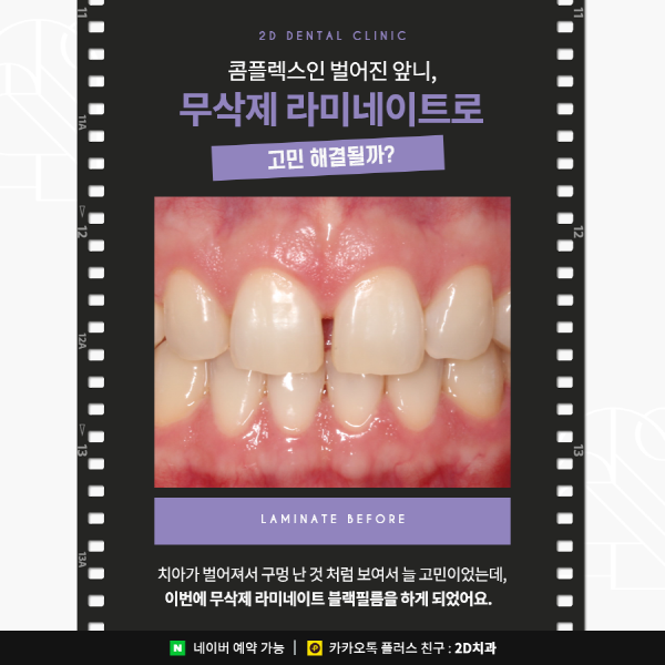 앞니 라미네이트 블랙필름의 효과성 A to Z 관련 이미지 2