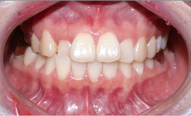 2D치과 2D교정으로 4개월만에 덧니 개선! 관련 이미지 9