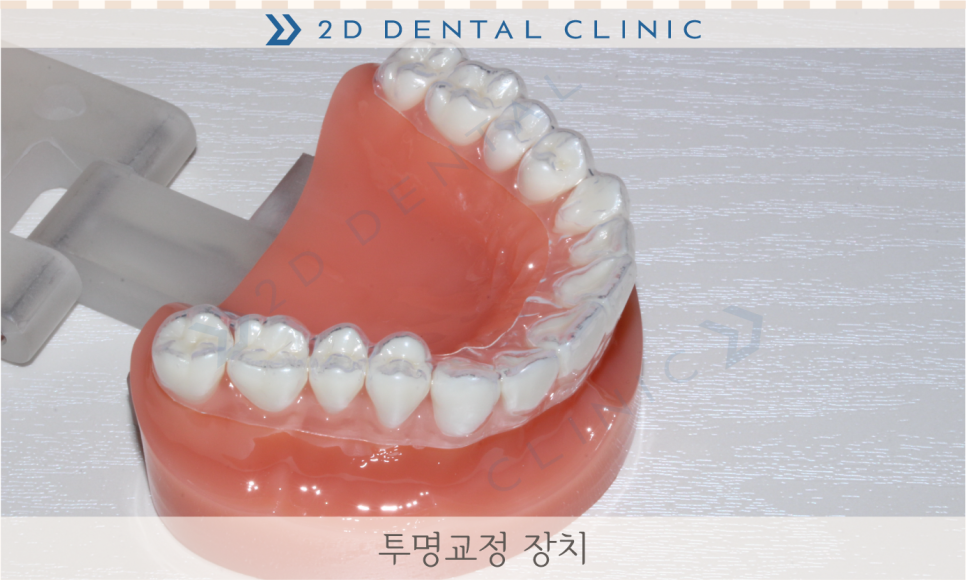 [교정상식] 치아교정, 그것이 알고싶다! 관련 이미지 8