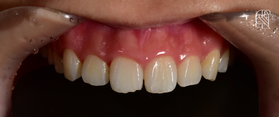 앞니깨짐 (앞니파절) 치료방법 세 가지 - 레진, 라미네이트, 크라운 관련 이미지 3