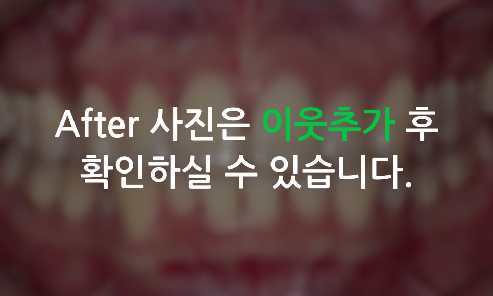 앞니틀어짐을 교정하는 방법은? (2D교정-설측교정) 관련 이미지 6