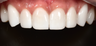 옥니 라미네이트 치아고민은 그만 치아삭제 없는 블랙필름으로 해결 관련 이미지 6