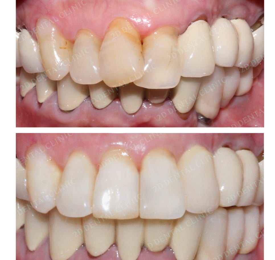 2D치과(투디치과) 교정일기 ㅣ 잇몸질환 예방되는 치아교정(feat.어머님교정) 관련 이미지 10