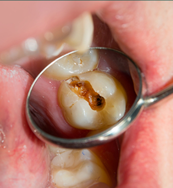 앞니라미네이트 치아삭제없는 무삭제라미네이트 블랙필름 관련 이미지 7