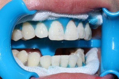 투디치과의 치아미백!! 관련 이미지 2