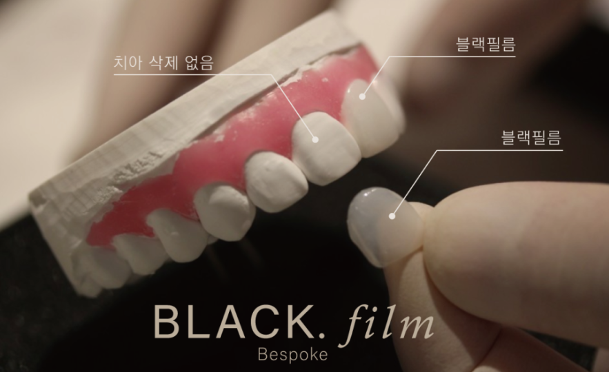 강남라미네이트 앞니변색 치아콤플렉스 개선은 블랙필름 관련 이미지 4