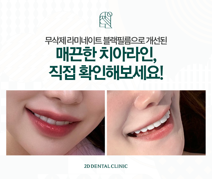 울퉁불퉁한 치아라인을 매끄럽게 무삭제라미네이트 블랙필름 관련 이미지 6