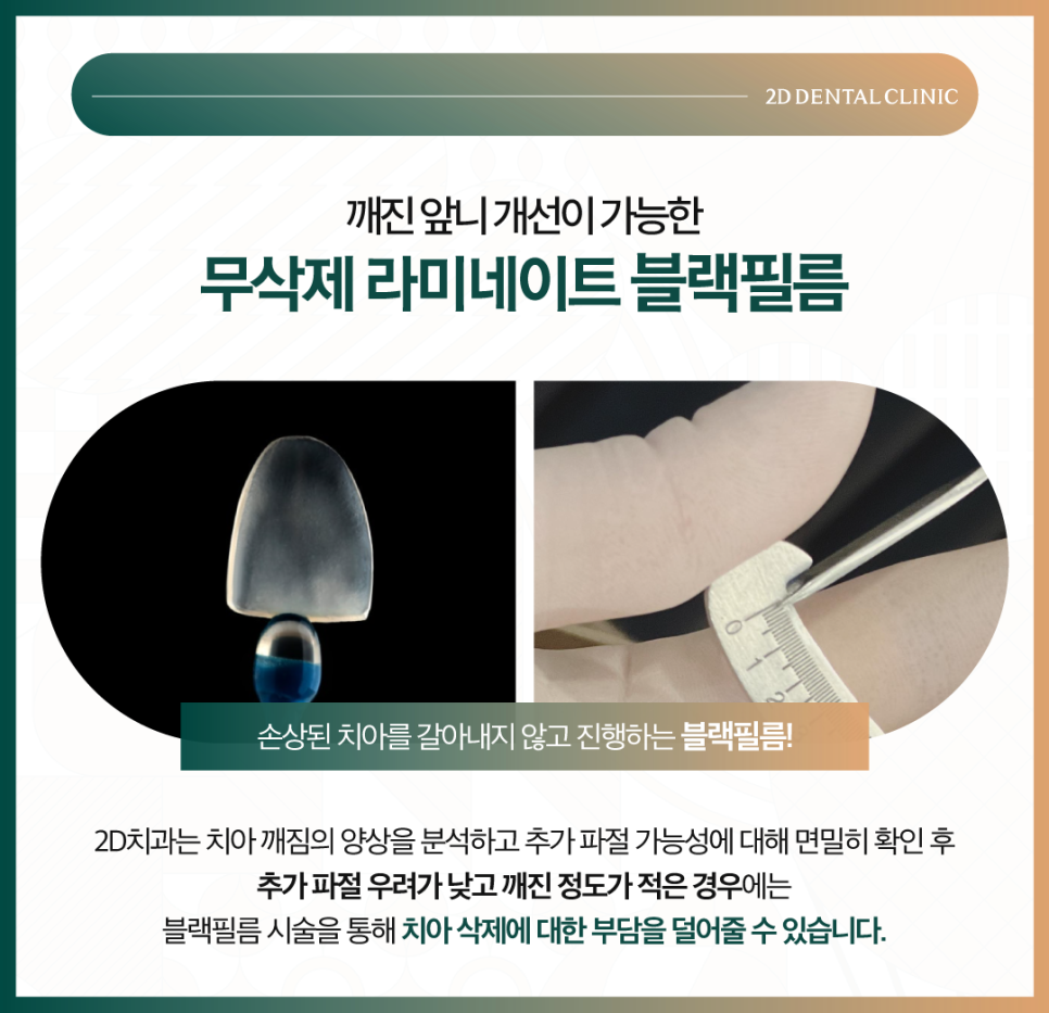 무삭제라미네이트비용 치아깨짐 파절된 앞니 보완하고 싶다면 관련 이미지 4