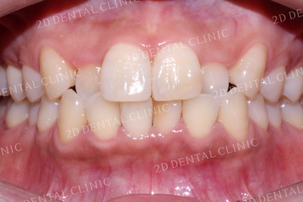 반대교합으로 물리는 치아를 바른 교합으로 교정하기! by.투디치과(2D치과) 관련 이미지 12