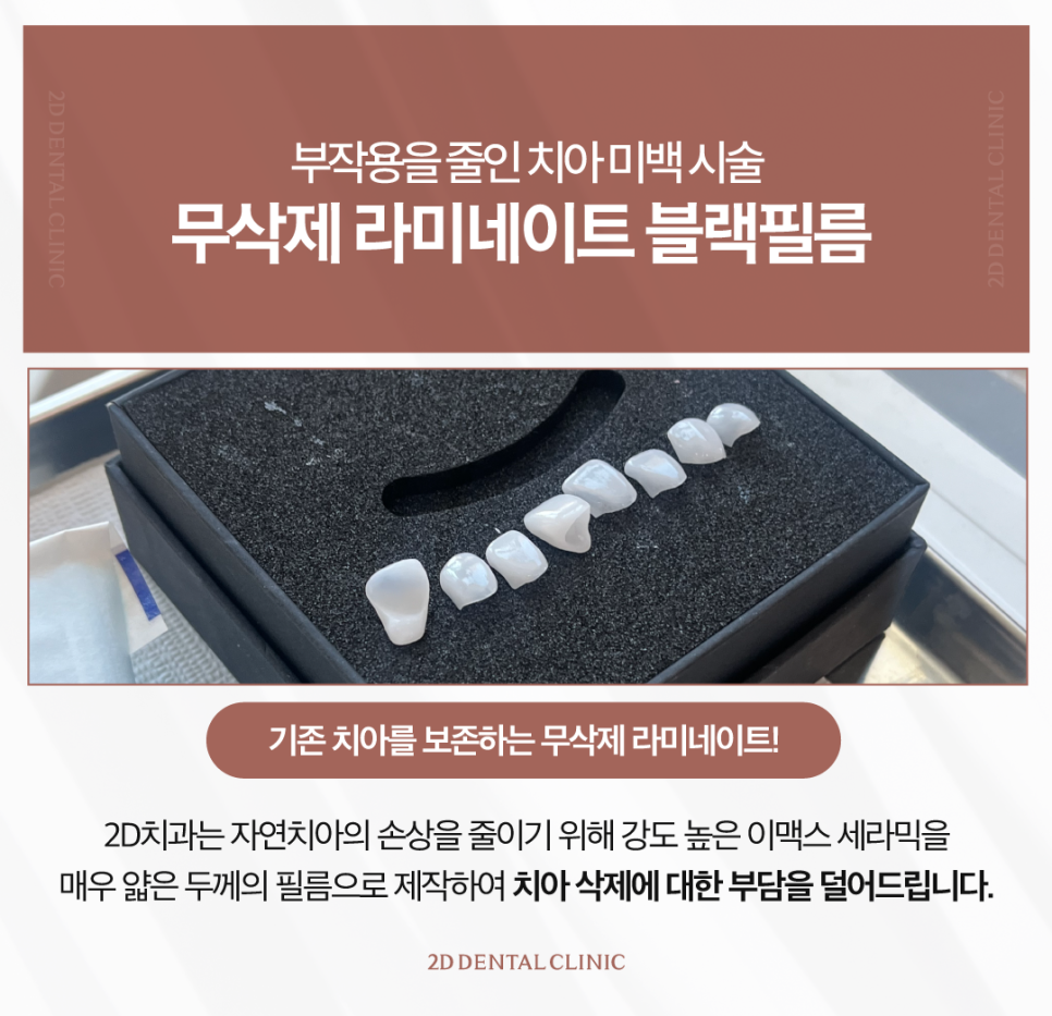 광주무삭제라미네이트 심미보철 치아 지키면서 예쁜 모양이 되려면 관련 이미지 4