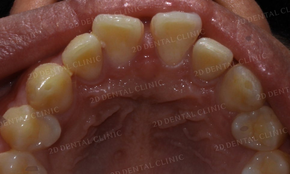 [앞니교정] 벌어진 앞니, 부분교정으로 앞니교정하기! by.2D치과(투디치과) 관련 이미지 6