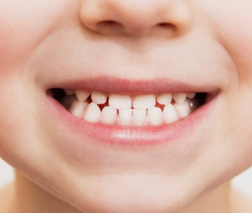 치아삭제 없는 블랙필름 무삭제라미네이트가격 관련 이미지 4