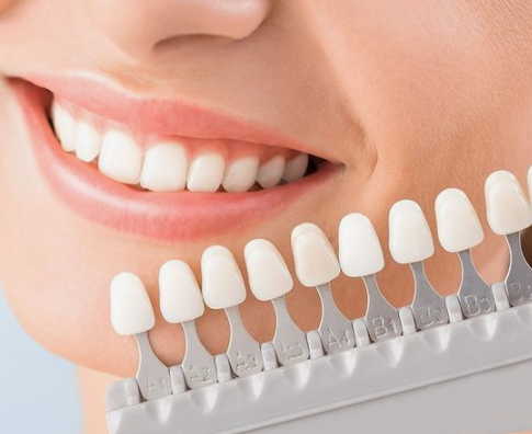 블랙필름 치아 삭제없는 무삭제라미네이트 후기 관련 이미지 6