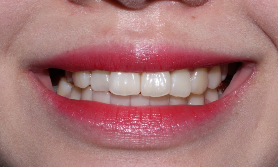 덧니 투명교정 8개월 치료 사례 관련 이미지 5