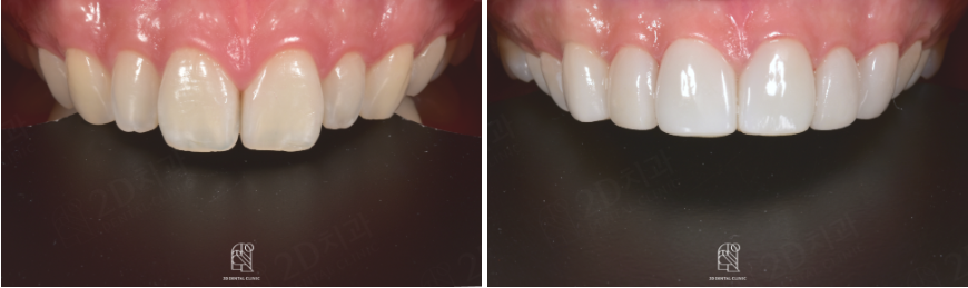 치아라미네이트 잘 하는 투디치과 관련 이미지 15