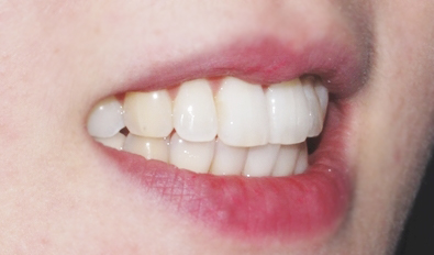 결혼식 6개월 남기고 급속교정으로 토끼이빨 탈출! 관련 이미지 3