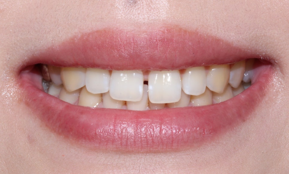 [교정상식] 나에게 딱 맞는, 치아교정? 관련 이미지 2