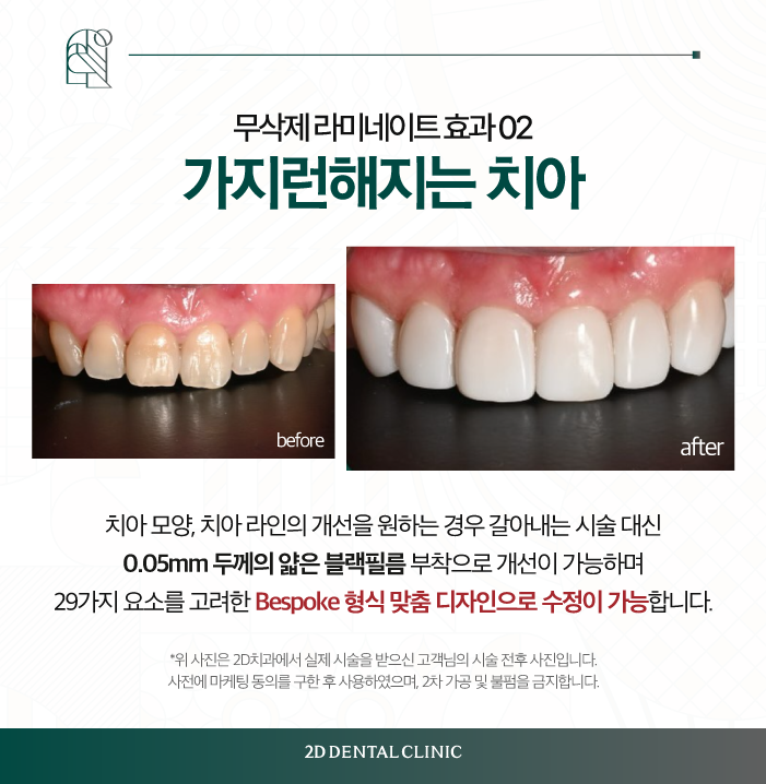 치아 무삭제 라미네이트 블랙필름 효과, 만족도는? 관련 이미지 5