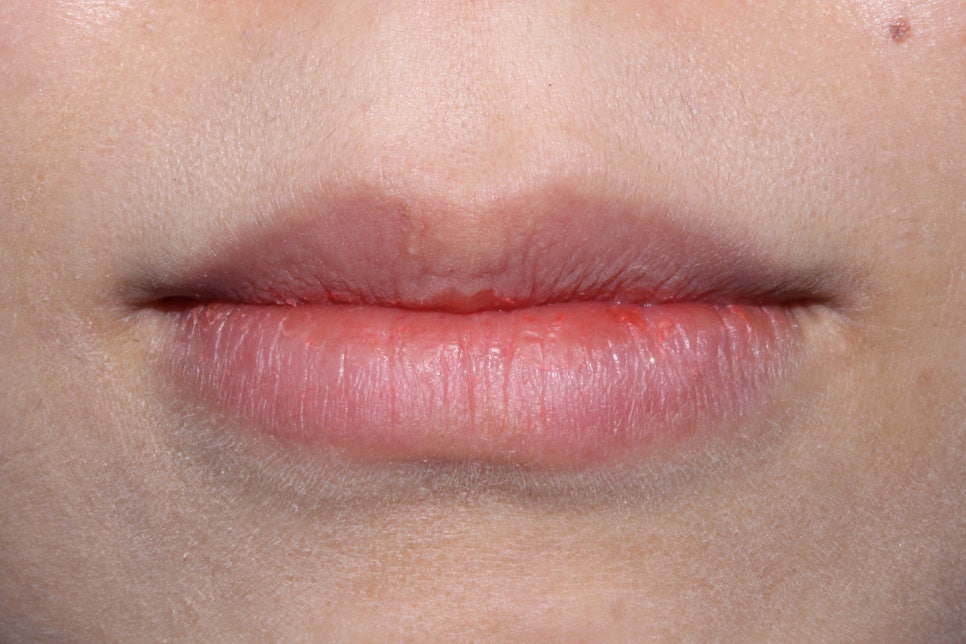 왜소치 뻐드렁니 교정 신논현역치과에서 관련 이미지 8