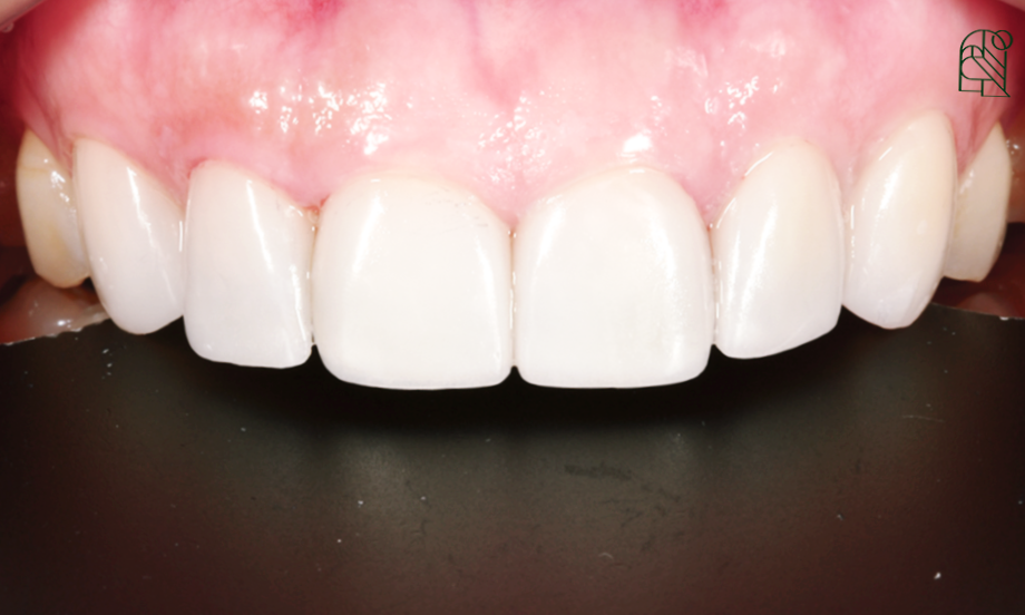 벌어진 앞니, 앞니벌어짐(diastema) 치료 - 레진, 교정, 라미네이트 관련 이미지 7