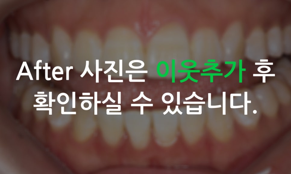 앞니돌출 급속교정 Case feat. 2D교정 관련 이미지 15