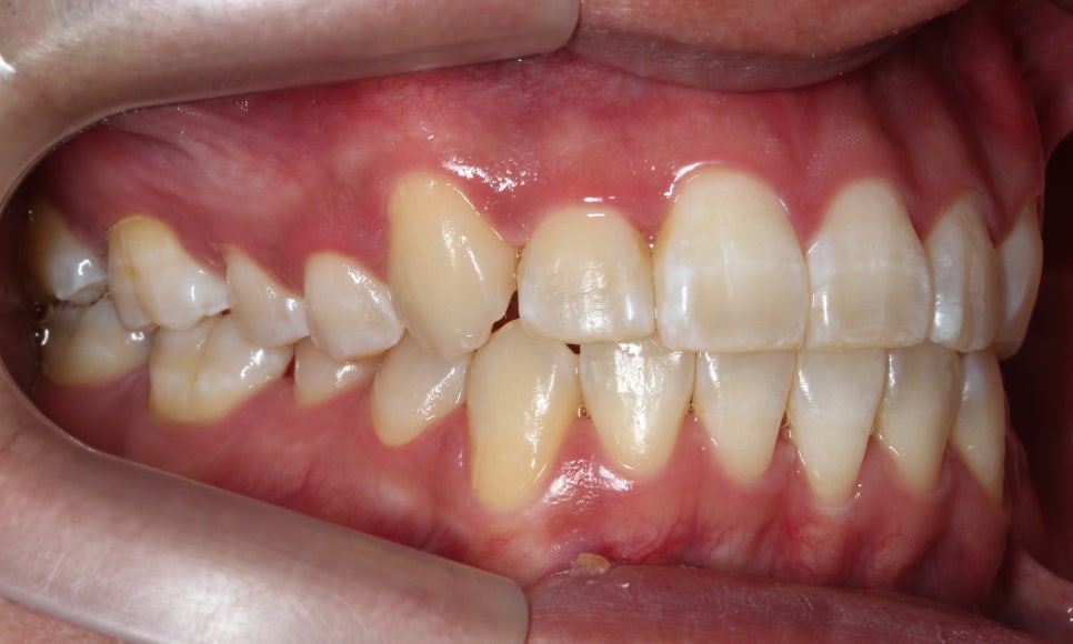 앞니 덧니 고민, 부분 설측 교정으로 해결한 사례 관련 이미지 14