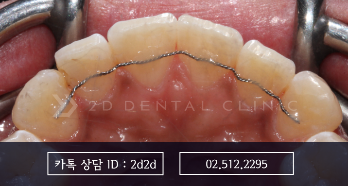 교정 유지 장치, 선택이 아닌 필수! 강남 2D치과 관련 이미지 5