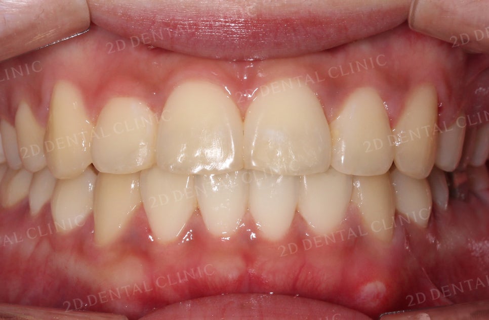 [앞니교정] 토끼앞니교정, 클리피씨 교정으로 완벽하게! by.투디치과(2D치과) 관련 이미지 9