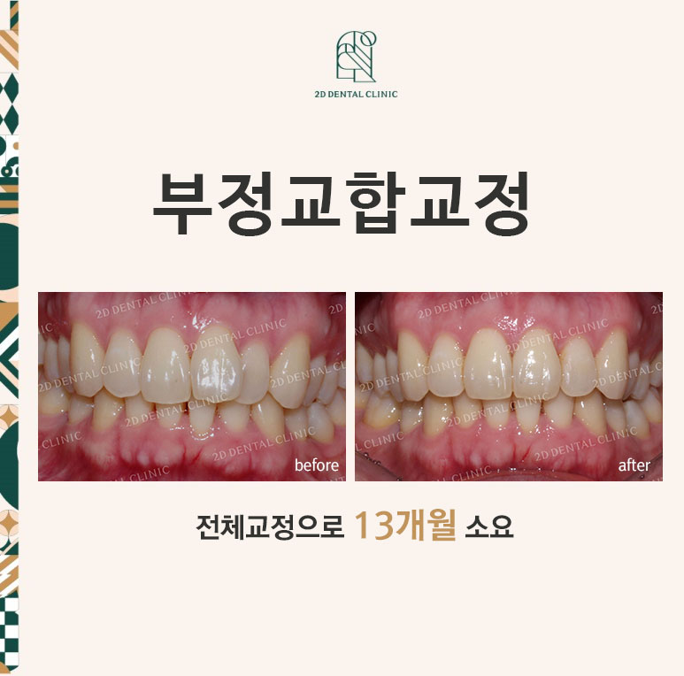 [투디교정] 부정교합 앞니교정을 투디교정으로 고르게! by.투디치과(2D치과) 관련 이미지 1