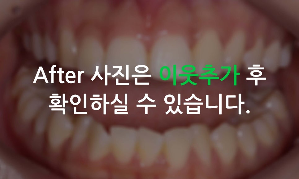 앞니틀어짐, 삐뚤어진 앞니를 부분교정하는 방법 관련 이미지 12