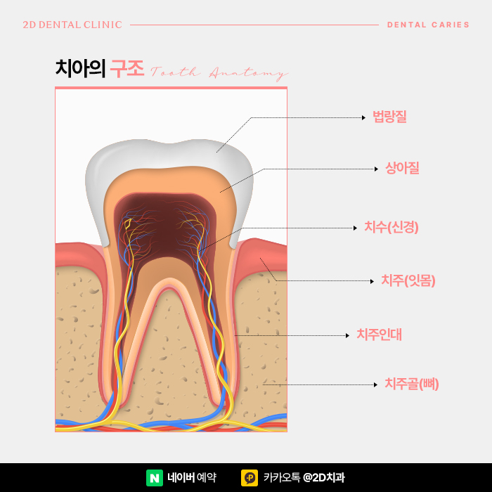 이빨썩음, 치아썩음 치과충치치료는 어떻게 할까? 선릉역치과에서 관련 이미지 2