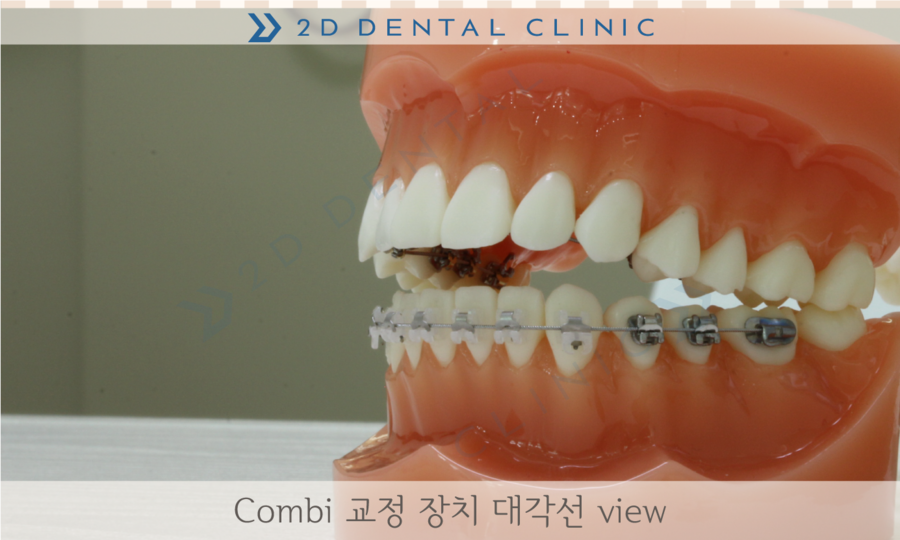 [교정상식] 설측교정,투명교정,콤비교정 장치종류 및 장단점! 관련 이미지 8