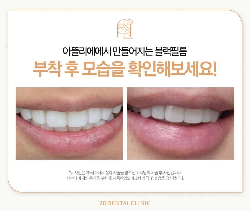 대치동치과 앞니치아변색 개선하는 무삭제 블랙필름 제작은? 관련 이미지 7