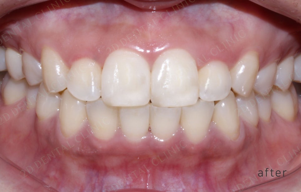 2D치과(투디치과) 교정일기ㅣ앞니덧니,반대교합 치아교정 완료!(ft.투디교정 전체교정) 관련 이미지 12