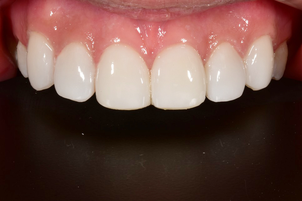 [투디치과] 블랙필름(비스포크) 치료의 다양한 사례 관련 이미지 11