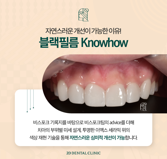 라미네이트무삭제 치아깨짐에도 자연스럽게 관련 이미지 5