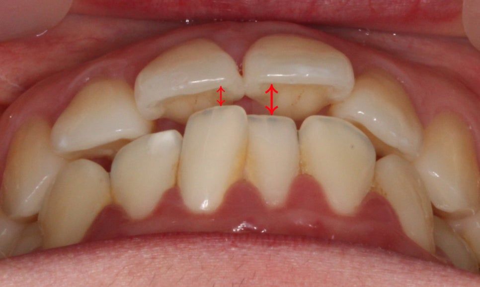입툭튀 교정 신논현역치과 전체교정으로 관련 이미지 2