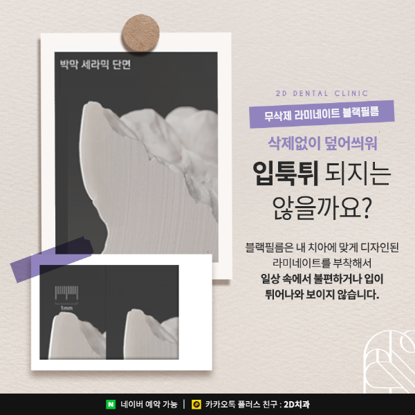 앞니 라미네이트 블랙필름의 효과성 A to Z 관련 이미지 4