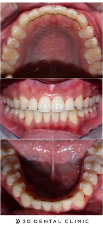비발치교정, 발치 없이 교정하기! 강남 2D치과 관련 이미지 7
