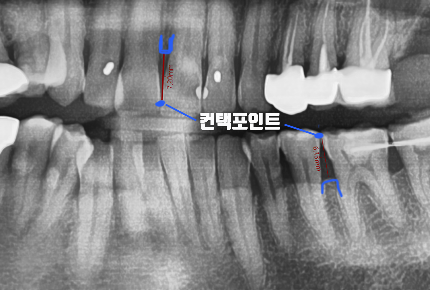 치아 블랙트라이앵글 원인, 예방, 치료 무삭제라미네이트 관련 이미지 5