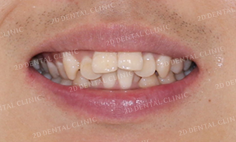 돌출앞니 교정, 튀어나온 입을 넣어보자! by.투디치과(2D치과) 관련 이미지 3