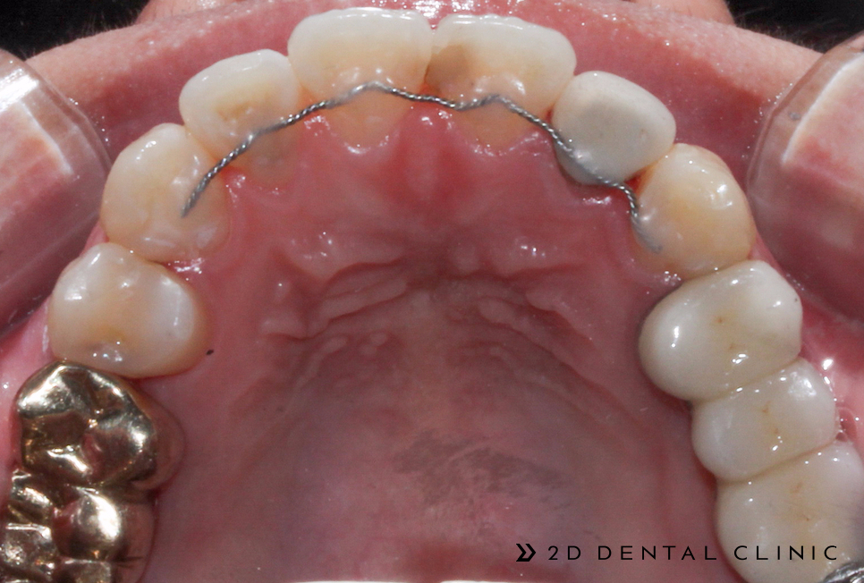 케이스로 확인하는 덧니 부정교합, 교정전문 2D치과 관련 이미지 6