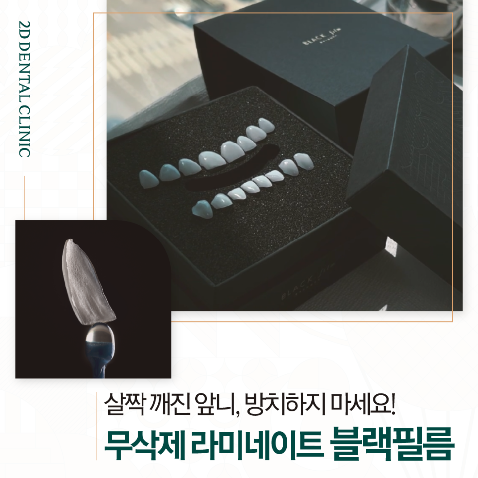 무삭제라미네이트후기 치아살짝깨짐 그대로 두어도 될까요? 관련 이미지 1