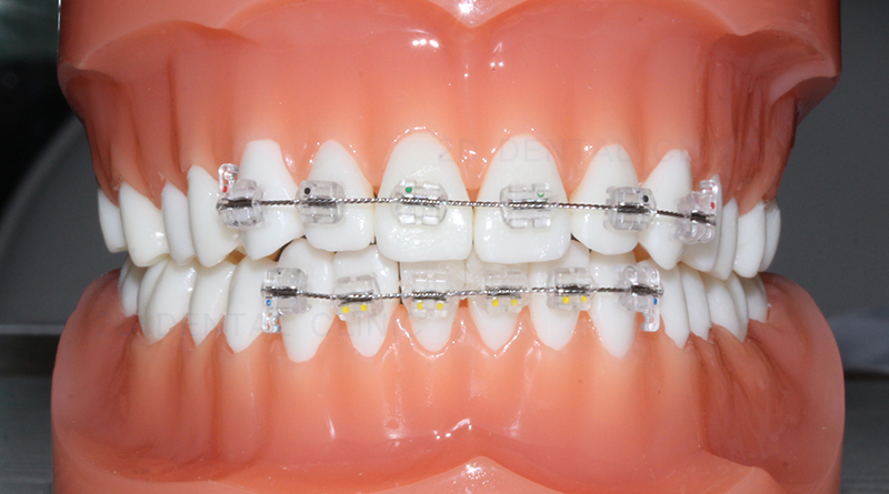 와,앞니 부분교정?!이라고?! 관련 이미지 2